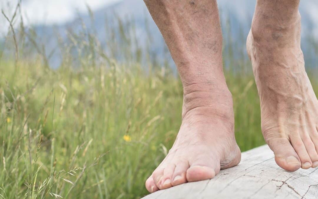 Piede diabetico: come prevenirlo