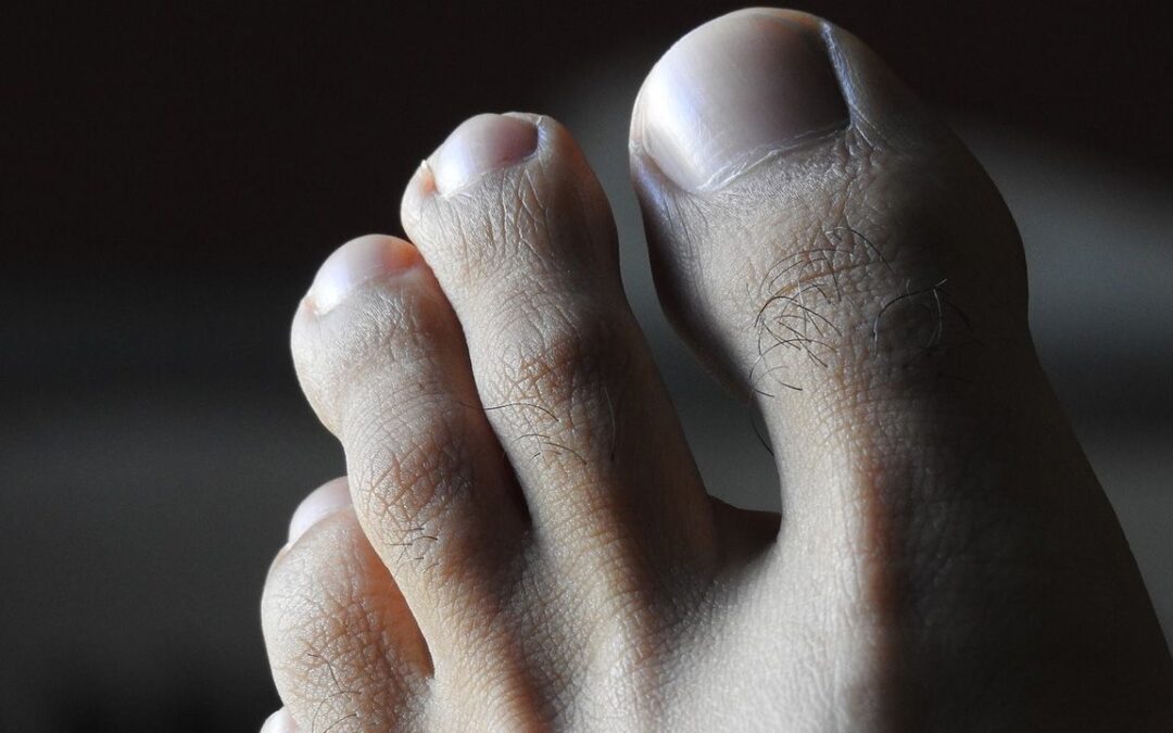 Rimedi efficaci per prevenire il prurito tra le dita dei piedi